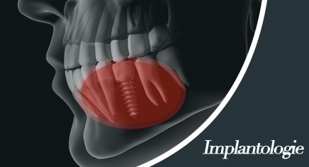 implantologie pontarlier